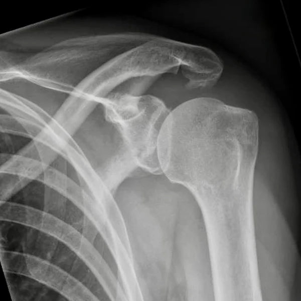 Impingement
